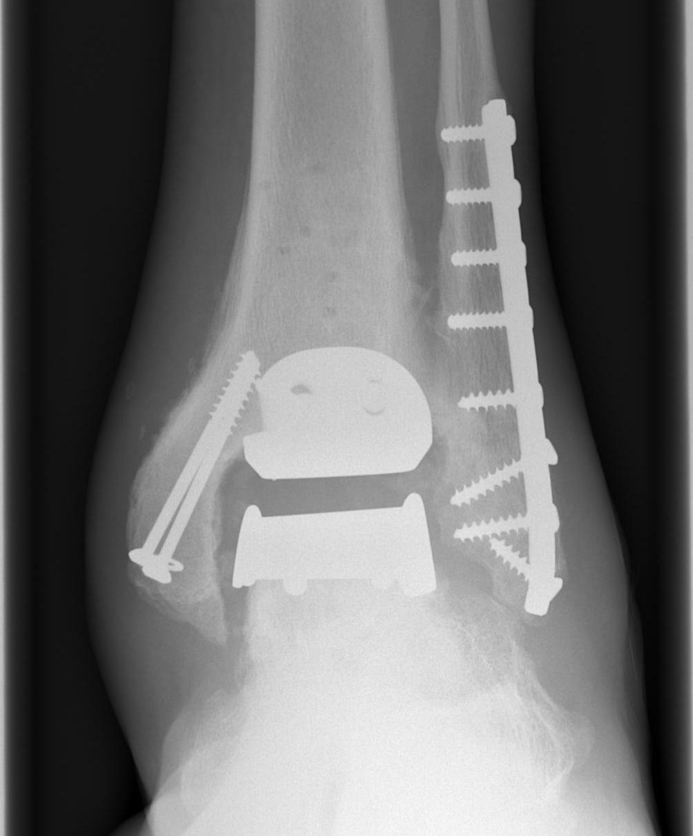 Ankle OA Arthroplasty AP